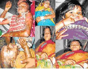 People lying in Darbhanga hospital with acid burn injuries.